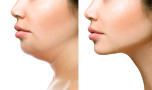 chin surgery