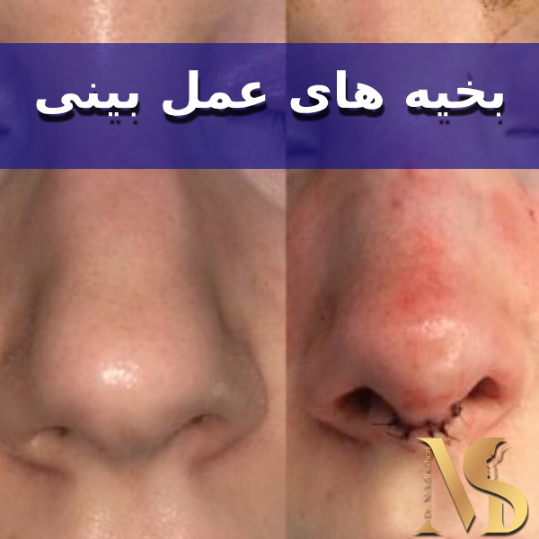 عکس بخیه های عمل بینی