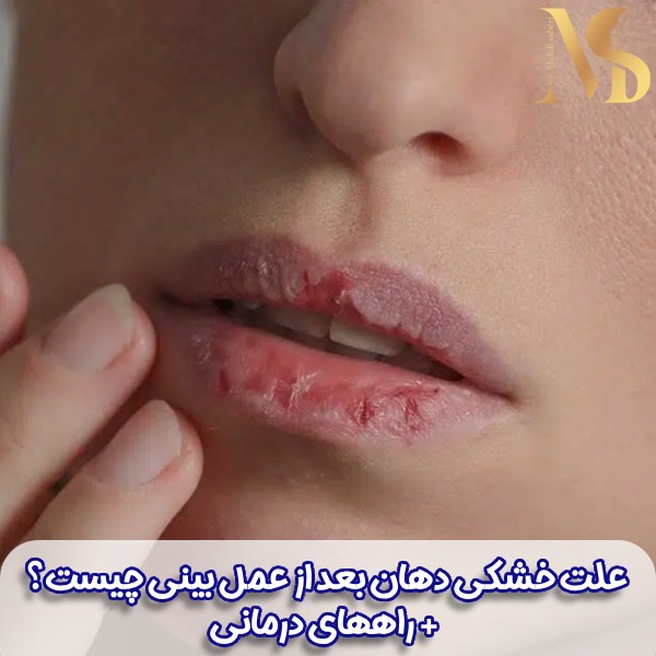 خشکی دهان بعد از عمل بینی